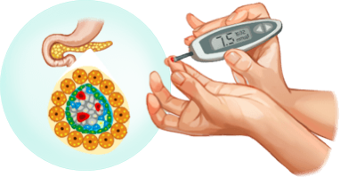 糖尿病diabetes mellitus